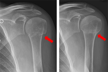 Proximal Humerus Fracture (Broken Shoulder)