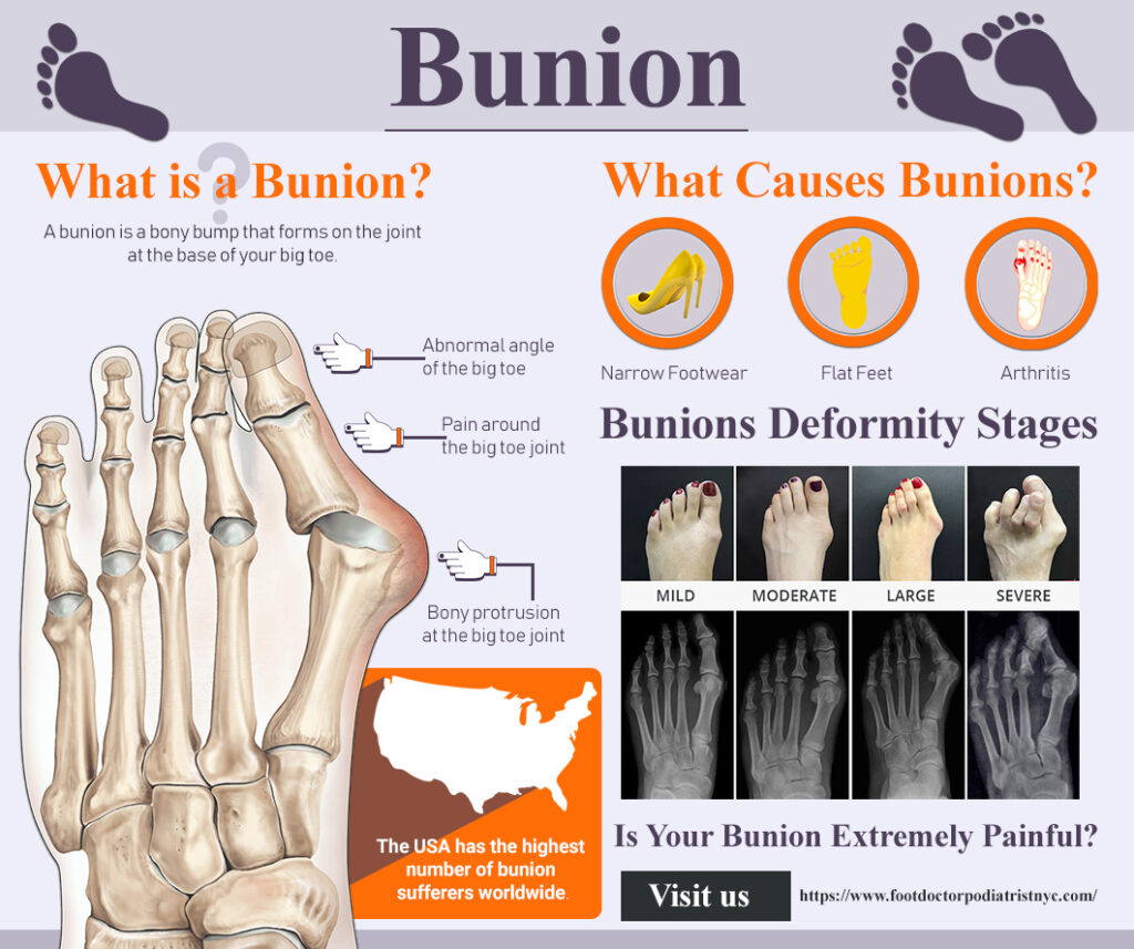 Bunion